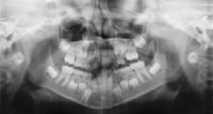 Pediatric Dentist Dr. Rob Oliver - Dental Radiographs (X-Rays)